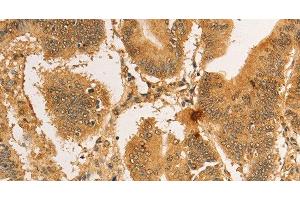 Immunohistochemistry of paraffin-embedded Human colon cancer tissue using RPL26L1 Polyclonal Antibody at dilution 1:30
