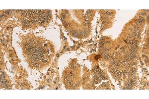 Immunohistochemistry of paraffin-embedded Human colon cancer tissue using RPL26L1 Polyclonal Antibody at dilution 1:30 (RPL26L1 anticorps)