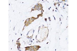Immunohistochemistry of paraffin-embedded Human breast cancer using NAA10 Polyclonal Antibody at dilution of 1:100 (40x lens). (NAA10 anticorps)