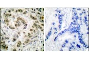 Immunohistochemistry analysis of paraffin-embedded human lung carcinoma tissue, using E2F4 Antibody. (E2F4 anticorps  (AA 51-100))