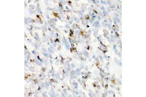 Immunohistochemistry of paraffin-embedded human esophageal cancer using CD68 antibody (ABIN5975414) at dilution of 1/100 (40x lens). (CD68 anticorps)