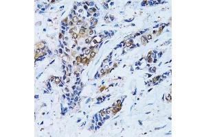 Immunohistochemistry of paraffin-embedded human breast cancer using IMPA1 antibody. (IMPA1 anticorps  (AA 1-277))
