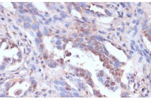 Immunohistochemistry of paraffin-embedded Human lung cancer using CARTPT Polyclonal Antibody at dilution of 1:100 (40x lens). (CARTPT anticorps)