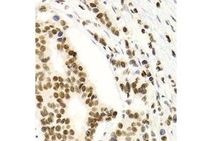 Immunohistochemistry of paraffin-embedded human breast cancer using NFKB2 Antibody. (NFKB2 anticorps  (AA 690-899))