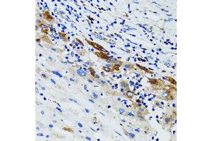 Immunohistochemistry of paraffin-embedded human liver cancer using USO1 antibody (ABIN1875291) at dilution of 1:100 (40x lens). (USO1 anticorps)