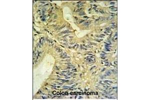 LXN Antibody (ABIN6242431 and ABIN6579060) IHC analysis in formalin fixed and paraffin embedded colon carcinoma followed by peroxidase conjugation of the secondary antibody and DAB staining. (Latexin anticorps)