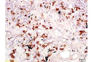 Formalin-fixed and paraffin embedded human lung carcinoma labeled with Anti-CD15/Fut4/SSEA-1 Polyclonal Antibody, Unconjugated (ABIN733193) at 1:200 followed by conjugation to the secondary antibody and DAB staining. (CD15 anticorps  (AA 251-295))