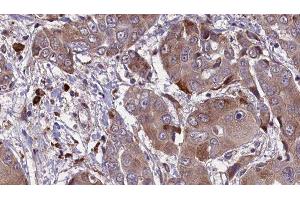 ABIN6276579 at 1/100 staining Human liver cancer tissue by IHC-P. (KCNE1 anticorps  (Internal Region))