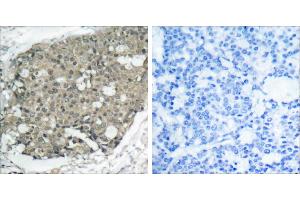 Peptide - +Immunohistochemical analysis of paraffin-embedded human breast carcinoma tissue using Akt (Ab-308) antibody (#B7005). (AKT1 anticorps  (Thr308))
