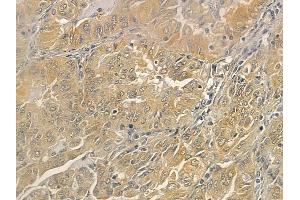 ABIN6262800 and ABIN6273259 at 1/100 staining human lung adenocarcinoma by IHC-P. (KIDINS220 anticorps  (Internal Region))