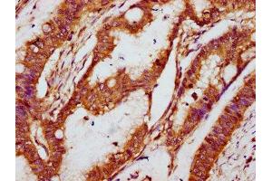 IHC image of ABIN7161004 diluted at 1:100 and staining in paraffin-embedded human colon cancer performed on a Leica BondTM system.