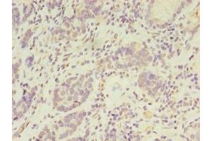 Immunohistochemistry of paraffin-embedded human gastric cancer using ABIN7169047 at dilution of 1:100 (PSKH2 anticorps  (AA 63-320))
