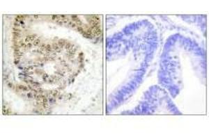 Immunohistochemistry analysis of paraffin-embedded human colon carcinoma tissue using hnRNP L antibody.