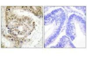 Immunohistochemistry analysis of paraffin-embedded human colon carcinoma tissue using hnRNP L antibody. (HNRNPL anticorps  (N-Term))