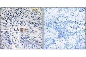 Immunohistochemistry analysis of paraffin-embedded human lung carcinoma tissue, using ZBTB40 Antibody. (ZBTB40 anticorps  (AA 1121-1170))