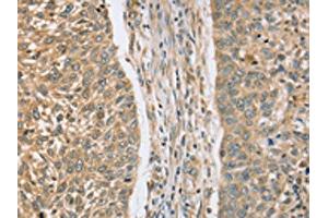 The image on the left is immunohistochemistry of paraffin-embedded Human lung cancer tissue using ABIN7130828(RASSF4 Antibody) at dilution 1/25, on the right is treated with fusion protein. (RASSF4 anticorps)