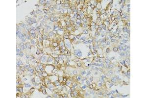 Immunohistochemistry of paraffin-embedded Human prostate cancer using MT-ND5 Polyclonal Antibody at dilution of 1:100 (40x lens).