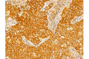 ABIN6265403 and ABIN6273018 at 1/100 staining Human lung cancer by IHC-P. (Syntaxin 11 anticorps  (Internal Region))