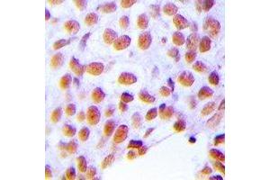 Immunohistochemical analysis of ZNF24 staining in human breast cancer formalin fixed paraffin embedded tissue section.