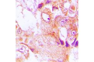 Immunohistochemical analysis of ABHD9 staining in human lung cancer formalin fixed paraffin embedded tissue section. (ABHD9 anticorps  (Center))
