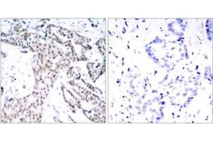 Immunohistochemistry analysis of paraffin-embedded human breast carcinoma, using STAT3 (Phospho-Ser727) Antibody. (STAT3 anticorps  (pSer727))