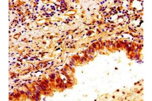 Immunohistochemistry of paraffin-embedded human lung cancer using ABIN7162750 at dilution of 1:100
