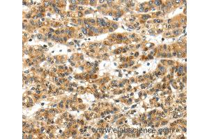 Immunohistochemistry of Human thyroid cancer using PAPPA Polyclonal Antibody at dilution of 1:50 (PAPPA anticorps)