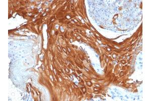 Formalin-fixed, paraffin-embedded human Basal Cell Carcinoma stained with Cytokeratin 6A (KRT6A) Mouse Monoclonal Antibody (KRT6A/2368).