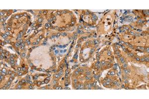 Immunohistochemistry of paraffin-embedded Human thyroid cancer using PLS3 Polyclonal Antibody at dilution of 1:30 (Plastin 3 anticorps)