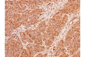 IHC-P Image Immunohistochemical analysis of paraffin-embedded DLD1 xenograft, using ACADM, antibody at 1:100 dilution. (Medium-Chain Specific Acyl-CoA Dehydrogenase, Mitochondrial (N-Term) anticorps)
