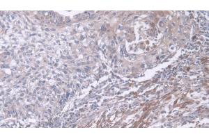 Detection of DUSP6 in Human Lung cancer Tissue using Polyclonal Antibody to Dual Specificity Phosphatase 6 (DUSP6)