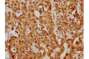IHC image of ABIN7169288 diluted at 1:200 and staining in paraffin-embedded human liver cancer performed on a Leica BondTM system. (PP5 anticorps  (AA 370-488))