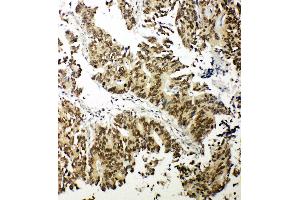 Anti-NRF1 antibody, IHC(P) IHC(P): Human Intestinal Cance Tissue