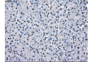 Immunohistochemical staining of paraffin-embedded Adenocarcinoma of colon tissue using anti-PPP5Cmouse monoclonal antibody. (PP5 anticorps)