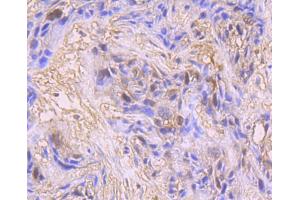 Paraformaldehyde-fixed, paraffin embedded Human breast carcinoma, Antigen retrieval by boiling in sodium citrate buffer (pH6) for 15min, Block endogenous peroxidase by 3% hydrogen peroxide for 30 minutes, Blocking buffer at 37°C for 20min, Antibody incubation with CDK1 (3E12) Monoclonal Antibody  at 1:50 overnight at 4°C, followed by a conjugated secondary and DAB staining.
