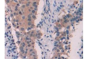 DAB staining on IHC-P; Samples: Human Lung cancer Tissue (MYL6 anticorps  (AA 4-146))