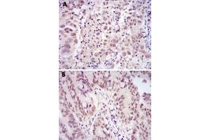 Immunohistochemical analysis of paraffin-embedded human endometrial cancer tissue (A) and rectum cancer tissue (B) using CDK9 monoclonal antibody, clone 1B5D10  with DAB staining.