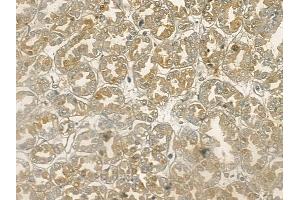 ABIN6255618 and ABIN6267141 at 1/100 staining human renal cell carcinoma by IHC-P. (MST1 anticorps  (pThr183))