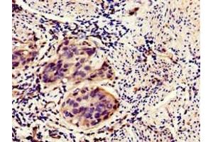 Immunohistochemistry of paraffin-embedded human bladder cancer using ABIN7155869 at dilution of 1:100
