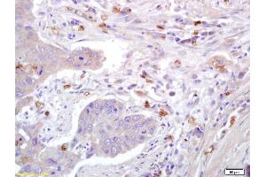 Formalin-fixed and paraffin embedded human lung carcinoma labeled with Anti-Caveolin-1 Polyclonal Antibody, Unconjugated (ABIN686752) at 1:200 followed by conjugation to the secondary antibody and DAB staining. (Caveolin-1 anticorps  (AA 2-120))