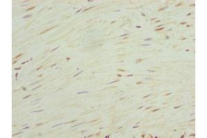 Immunohistochemistry of paraffin-embedded human colon cancer using ABIN7168034 at dilution of 1:100 (RhoF anticorps  (AA 1-170))