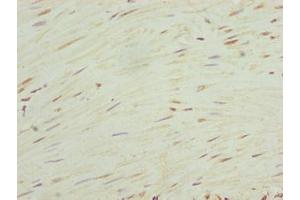 Immunohistochemistry of paraffin-embedded human colon cancer using ABIN7168034 at dilution of 1:100
