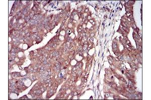 Immunohistochemical analysis of paraffin-embedded rectum cancer tissues using EIF2AK2 mouse mAb with DAB staining.