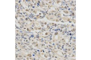 Immunohistochemistry of paraffin-embedded human stomach cancer using SPHK1 antibody at dilution of 1:200 (x400 lens). (SPHK1 anticorps  (AA 50-384))