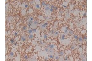 Detection of MBP in Human Glioma Tissue using Polyclonal Antibody to Myelin Basic Protein (MBP)