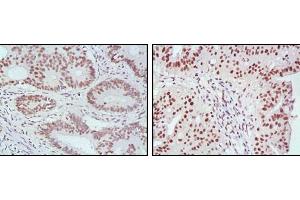 Immunohistochemical analysis of paraffin-embedded human rectum cancer (left) and ovarian cancer (right) tissues, showing nuclear localization with DAB staining using MLH1 mouse mAb. (MLH1 anticorps  (AA 381-483))