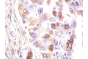 Immunohistochemistry analyzes of RFA2 antibody in paraffin-embedded human lung carcinoma tissue.