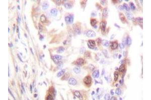 Immunohistochemistry analyzes of RFA2 antibody in paraffin-embedded human lung carcinoma tissue. (RPA2 anticorps  (AA 115-129))