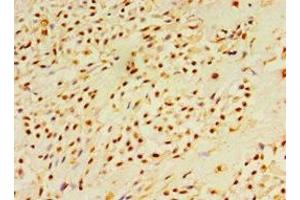 Immunohistochemistry of paraffin-embedded human breast cancer using ABIN7150785 at dilution of 1:100