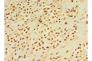 Immunohistochemistry of paraffin-embedded human breast cancer using ABIN7150785 at dilution of 1:100 (DUSP7 anticorps  (AA 160-419))